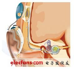 圖5,植入耳蝸將聲音轉(zhuǎn)換為電脈沖，送給聽覺神經(jīng)。話筒將聲音捕捉給聲音處理器（a）。聲音處理器將聲音轉(zhuǎn)換為詳細(xì)的數(shù)學(xué)信息 （b）。