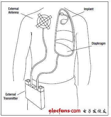圖7,呼吸起搏器帶有用于膈神經(jīng)刺激的植入電極以及RF接收器，還有向植入體發(fā)射RF信號的外部天線，完成刺激起搏功能