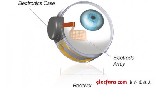 新的實驗中，研究者們繞過了攝像頭，直接激活了受試者視網(wǎng)膜上的6個電極
