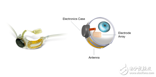 Argus II仿生眼，幫助盲人重見光明!